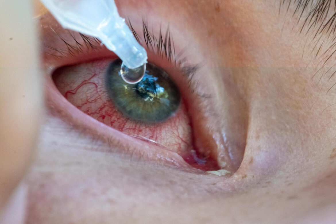 Common Misdiagnoses For Pink Eye Explained